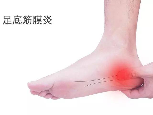 足底筋膜炎并非炎症,缓解疼痛建议定制矫正鞋