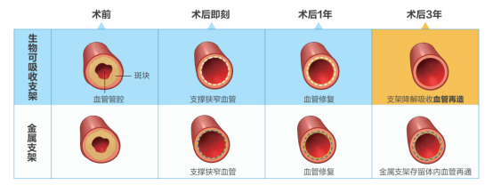全降解支架：“介入无植入”创新产品为冠心病患者带来丰富选择