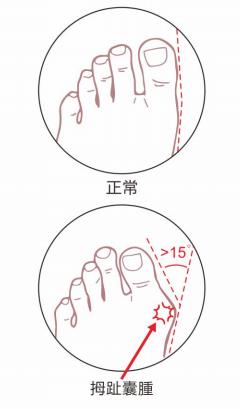 拇外翻角度测量方法图片