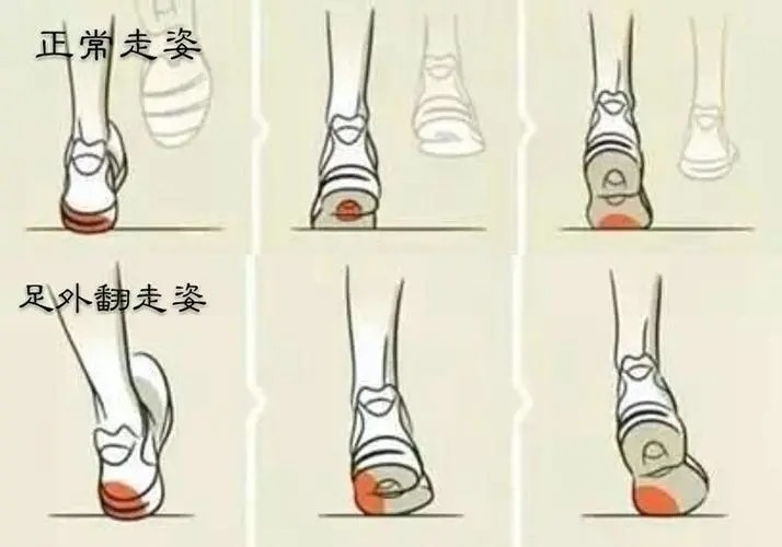 了解矫正鞋垫的正确使用方式，效果会更好