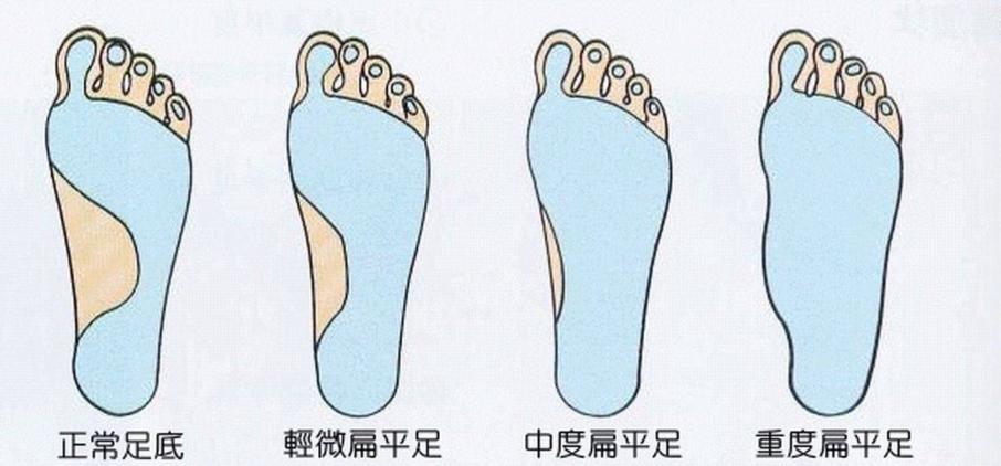 平脚和正常脚的区别图图片