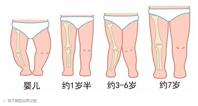 严重O/X形腿需定制矫正鞋干预，帮助孩子足腿健康发育